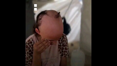 8YROLD PALESTINIAN GIRL SAMA TABIL LOST HER HAIR DUE2STRESS & TRAUMA CAUSED BY ISRAEL’S WAR ON GAZA