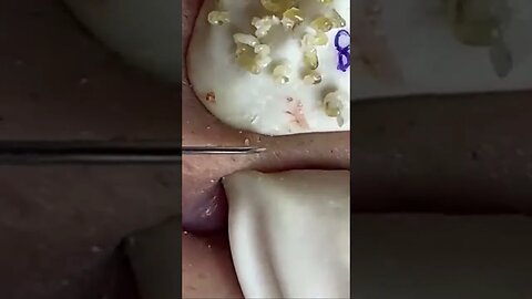 blackhead removal, blackheads, blackheads and acne, pimples removal, #short 42