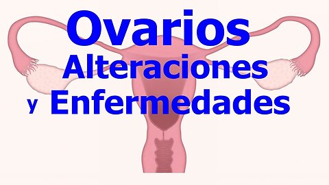 QUISTES, OVARIO POLIQUÍSTICO, ANEXITIS, INFLAMACIÓN DEL OVARIO, SALPINGITIS, CÁNCER DE OVARIOS...