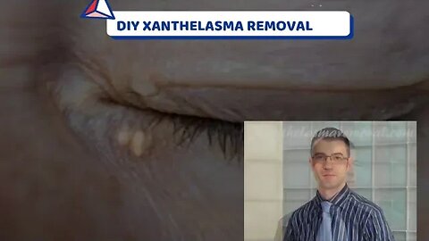 DIY XANTHELASMA REMOVAL