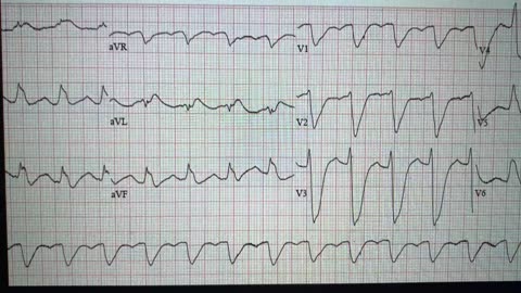 Sudden Cardiac Arrest