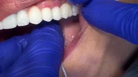 Flossing with a dental bridge