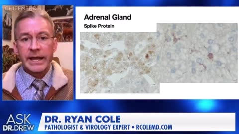 🚨 Dr. Ryan Cole Shares New Autopsy Results Showing Vaccine Spike Protein in the Adrenal Gland