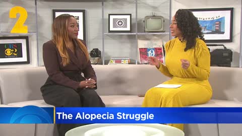 Local dermatologist shares the struggle of alopecia