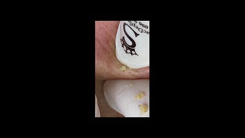 Best satisfying pimples popping video