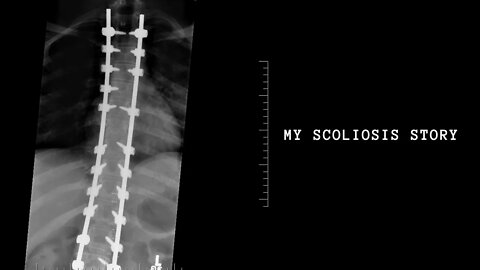 My Scoliosis Story || 4 Rods & 36 Screws