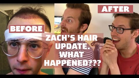 Zach From The Try Guys Hair Transplant Update- HT Class #21