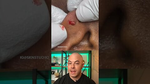 Doctor reacts to big cyst extraction on the ear! #dermreacts #doctorreacts #pimplepop #cystpop