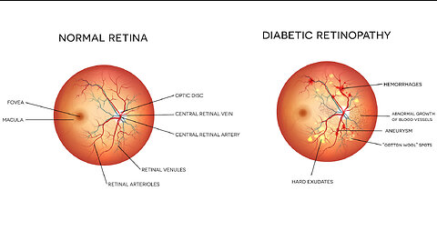 Can diabetes affect your eye health?