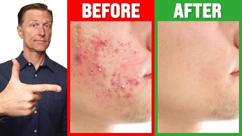 The FASTEST Way to Rid Acne - Dr. Berg