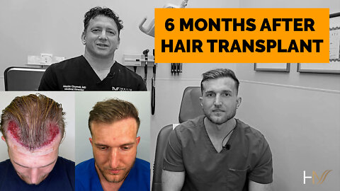 Amazing Hair Transplant Results After Only 6 Months!