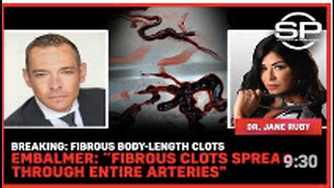 BREAKING: Fibrous Body-Length Clots Embalmer: "Fibrous Clots Spread Through Entire Arteries"