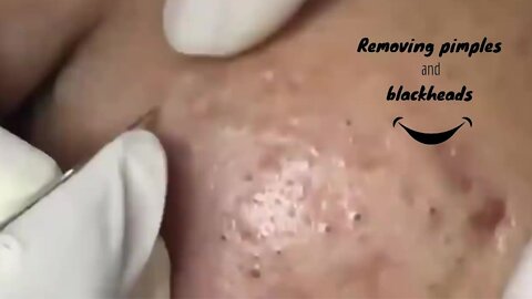 Removing many pimples - relaxing