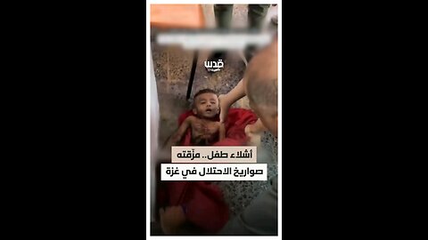 طفل مزقته صواريخ الاحتلال إلى نصفين في غزة.