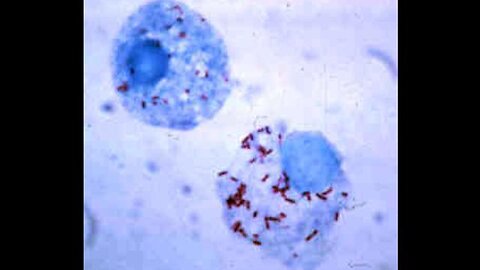 Microparasites From Insect Bites Cause Fevers and Pain-Not "Bacteria"