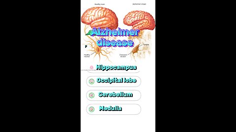 Alzheimer’s disease question answers MCQs : neurological disorder,#disease #mcqs #3dmedico 🧠👩🏻‍🦼