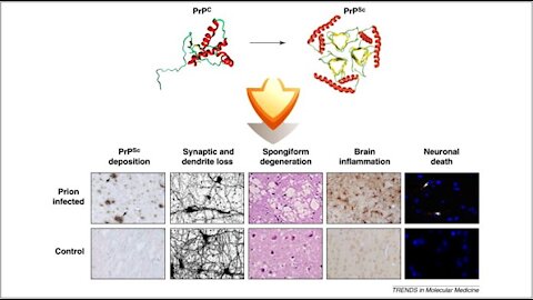 Shock! mRNA COVID-19Vax May Progressively Degenerate Your Brain From Prion Disease!