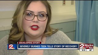 Burn survivor brings awareness to National Burn Week