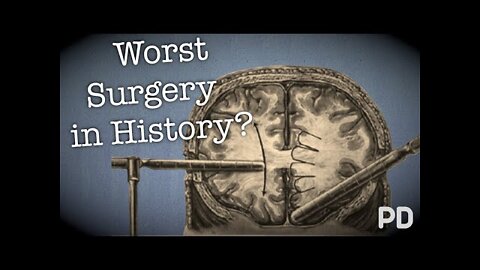 The Dark side of Science: The Lobotomy, the worst surgery in history!! (Documentary)