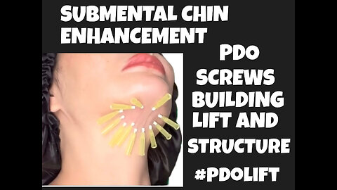 Submental Chin Neck Tightening Using Mono