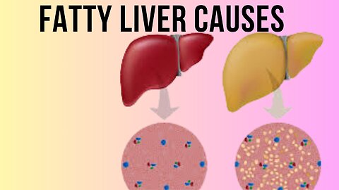 Fatty liver causes