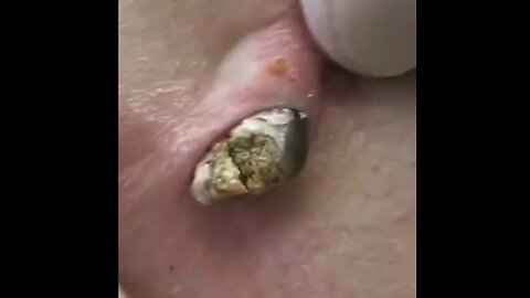 Massive Dilated Pore of Winer Removal