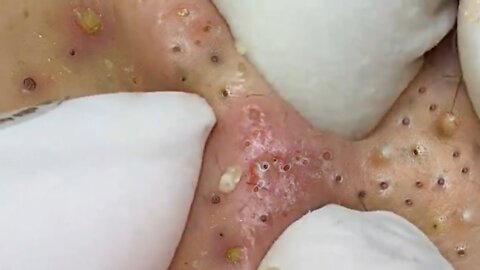 Removing Acne and Blackheads Treatment, #34