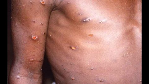 WHO Considering Renaming Monkeypox Over Concerns of Label's Stigma