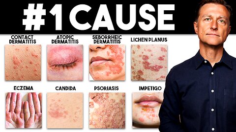 The MOST Common Deficiency in All Skin Diseases (Dermatitis)