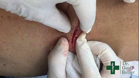 Removal of a Metastatic Adenocarcinoma Lesion on the skin