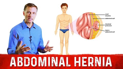 What Causes An Abdominal Hernia? – Dr.Berg on Hernia Causes