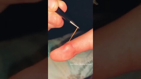 Remoção de Espinho no Dedo - Thorn Removal on Finger - Satisfatório - Just Relax | Apenas Relaxe