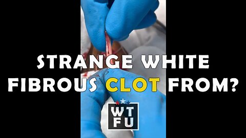 Removal of strange white fibrous clots, from the right jugular vein