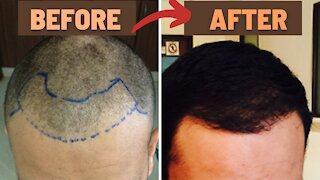 Hair transplant process FUE