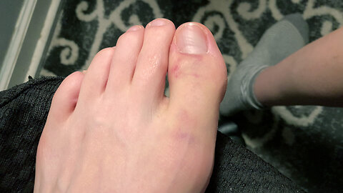 Broken Toe (part 2) | Weird Wednesday