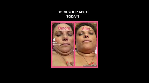 Non Surgical Face Lift