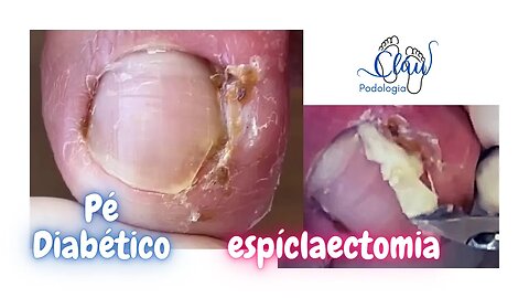 Corte INCORRETO + Pé DIABÉTICO = Unha ENCRAVADA #unhas #pes #dor #podologia #procedimento #diabetes