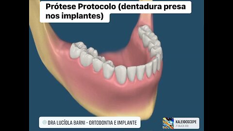 Prótese Protocolo