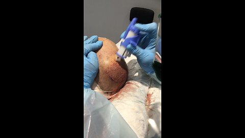 Direct hair transplantation