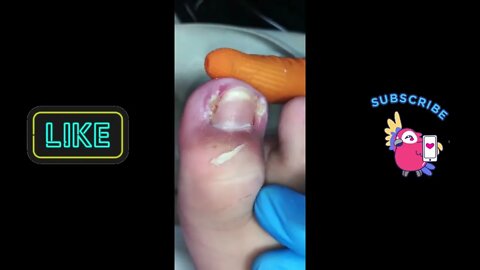 Ingrown Toe Nail Removal #ingrowntoenail #ingrownnail #ingrown #ingrowntoenailremoval