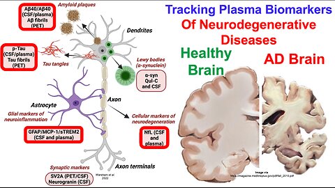 Kynurenine/Tryptophan Is Associated With Biomarkers Of Neurodegenerative Disease