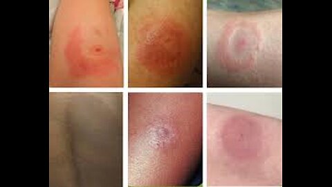 Understanding Lyme Disease Rash - Medical Basics With Photos