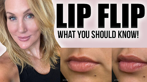 Tox Lip Flip - What You Should Know! #botox #lipflip