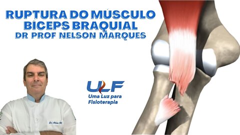 RUPTURA DO MÚSCULO BÍCEPS BRAQUIAL - Dr. Prof. Nelson Marques