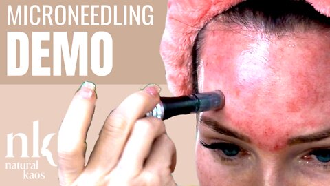 Microneedling Demo 2021