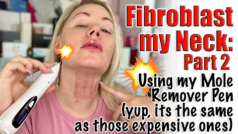 Fibroblast my Neck with Mole Pen : Part 2 | Code Jessica10 Saves you Money!