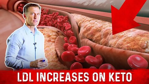 Cardiologist (Dr. Nadir Ali) Explains LDL Bad Cholesterol Spike With Keto – Dr.Berg