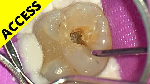 MAX MOLAR ACCESS (Ep.1 of Whole Case)