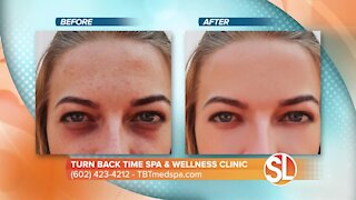 Watch how Turn Back Time Spa & Wellness Clinic can remove dark spots, age spots and much more from your skin