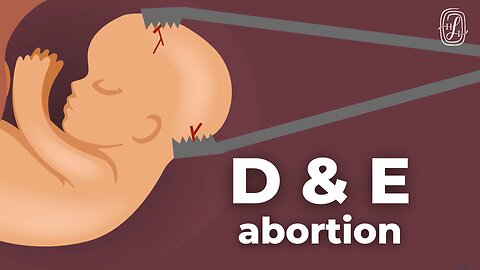 How Does D&E Abortion Work?